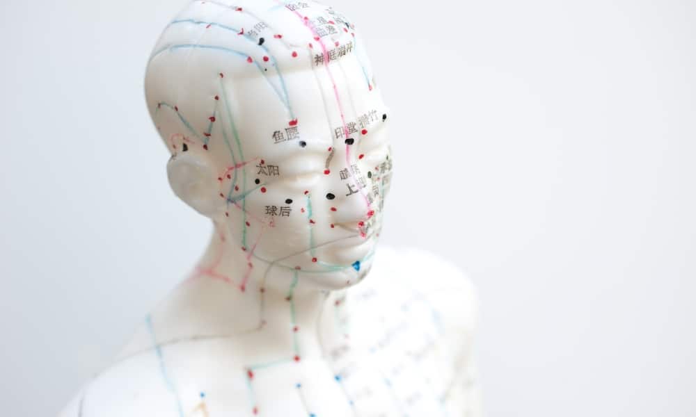 acupuncture